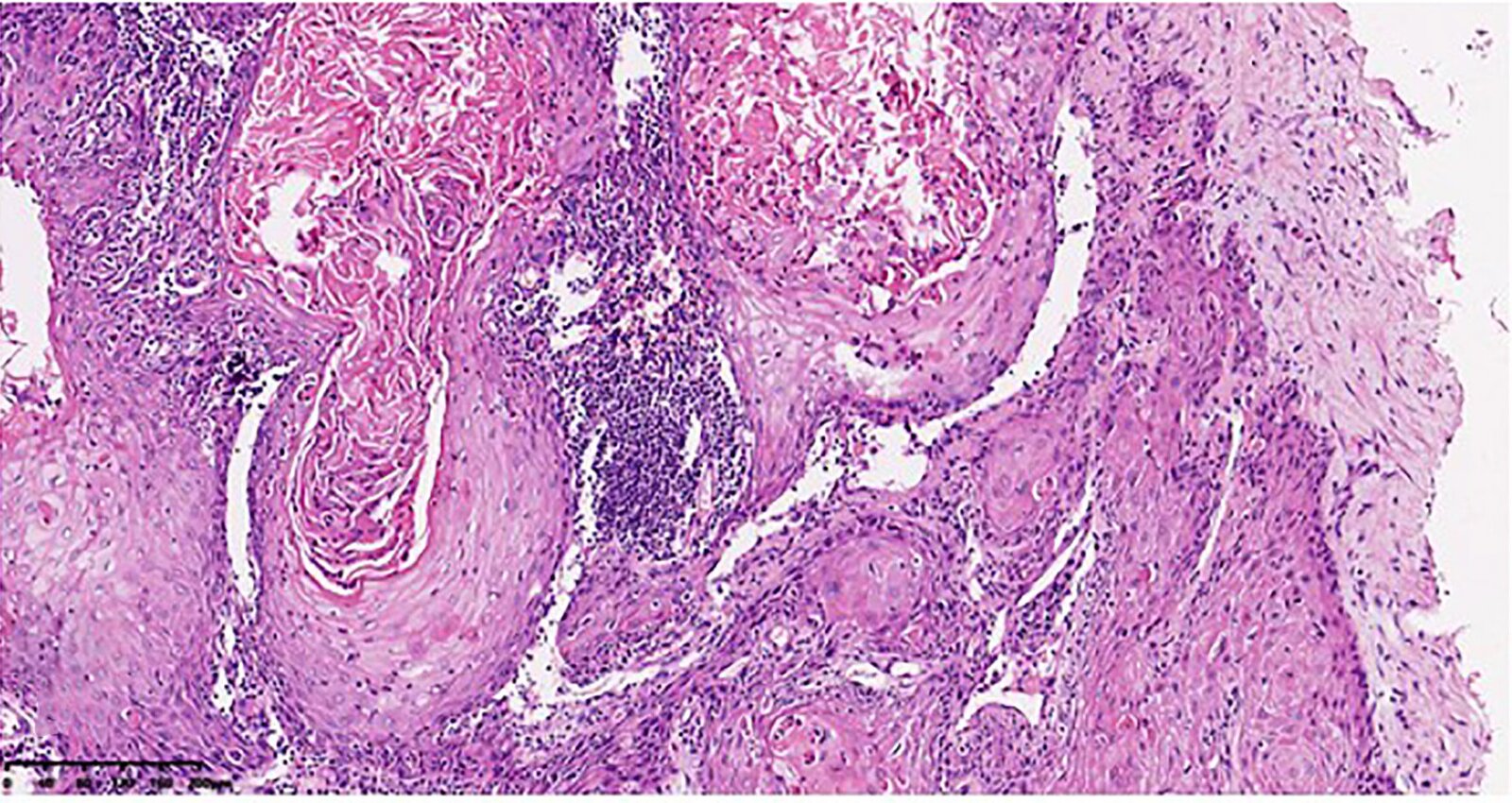 Verrucous carcinoma of the vulva