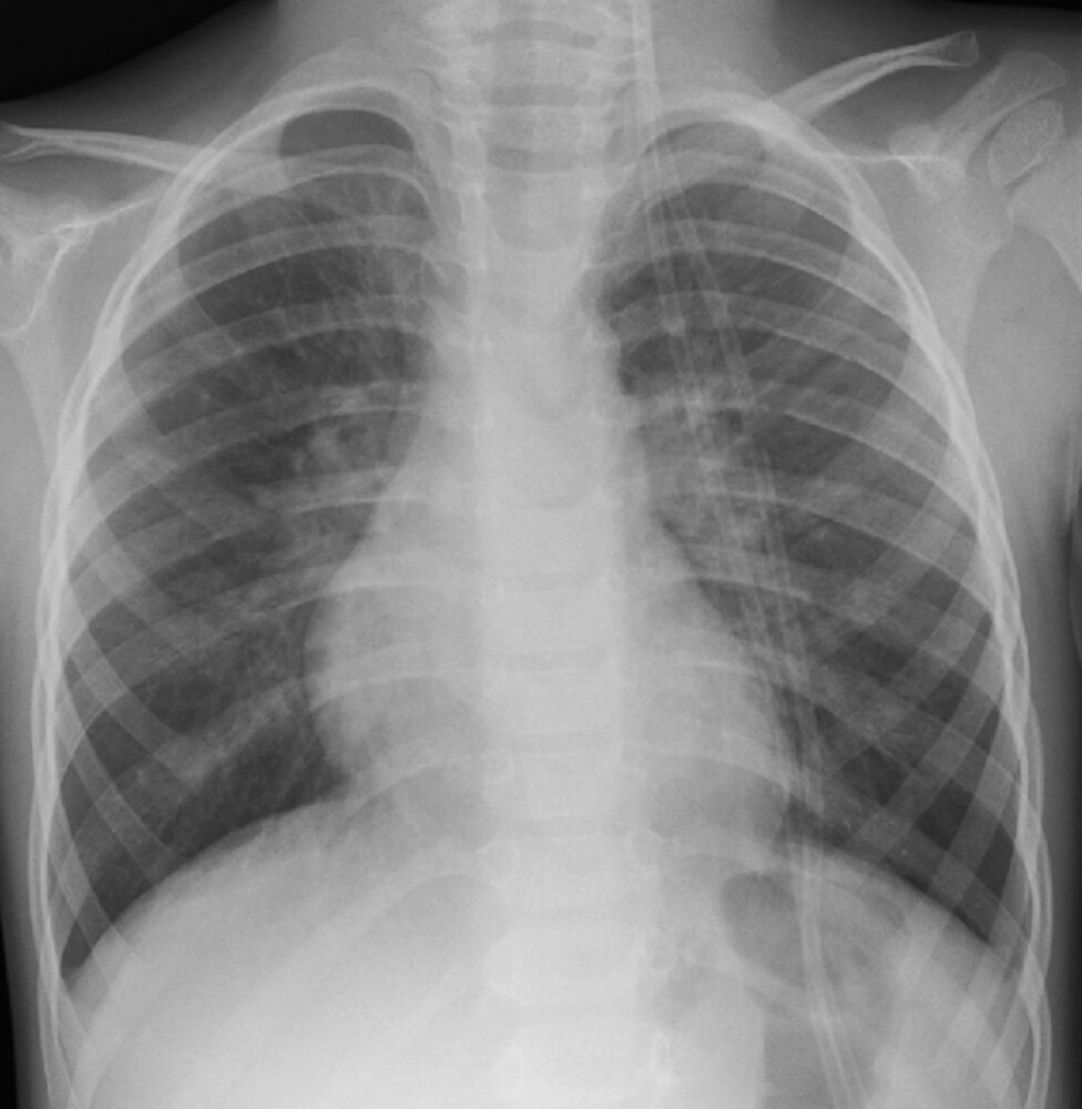 Viral bronchiolitis