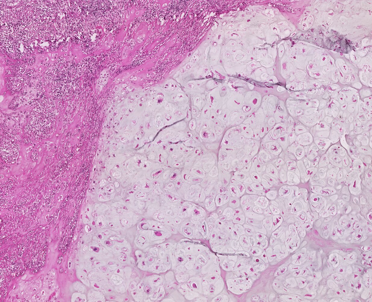 Chondrosarcoma