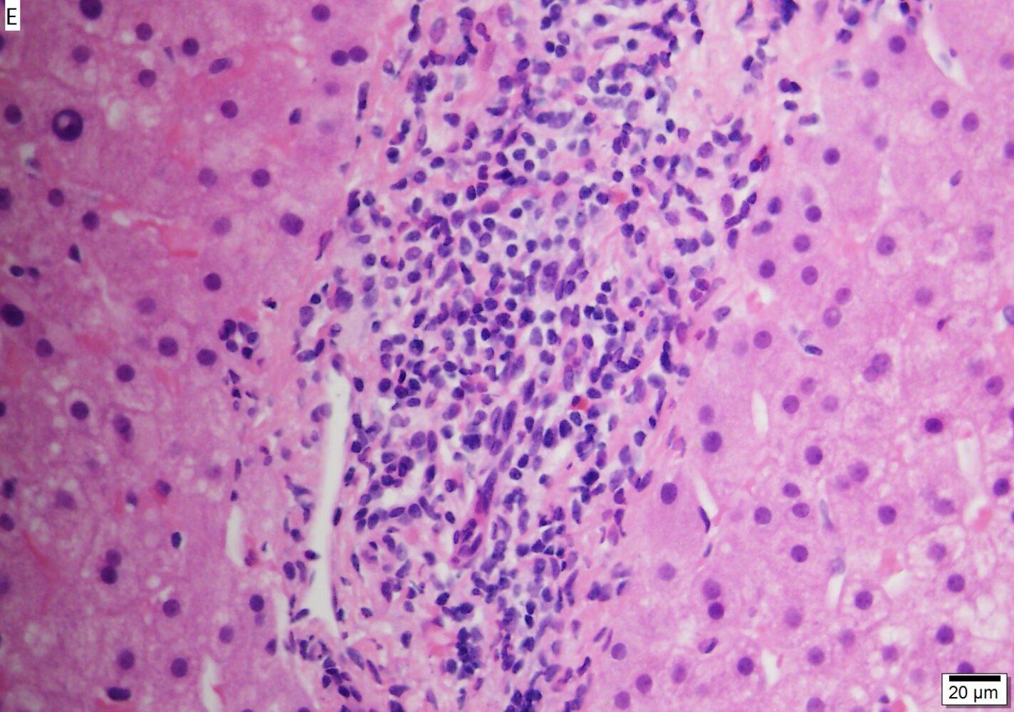 Chronic hepatitis B