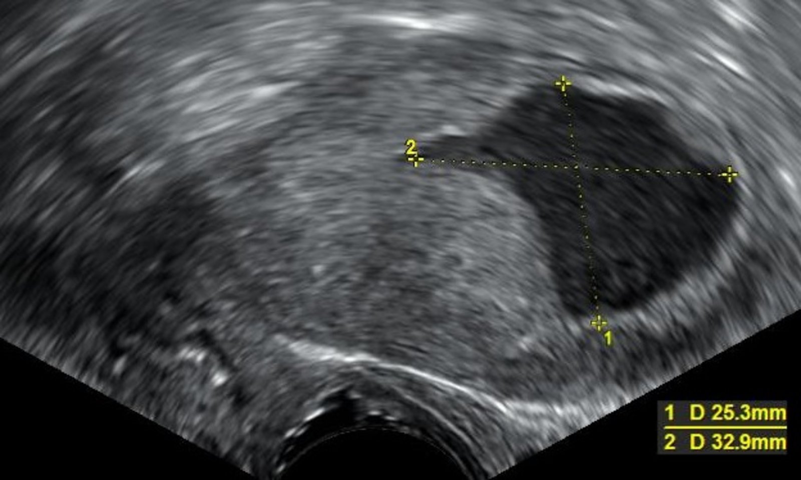 Endometrial fluid in endometrial carcinoma
