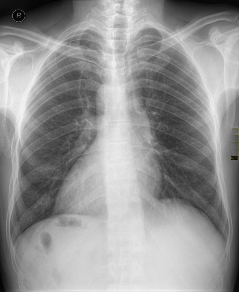 Situs inversus with dextrocardia (situs inversus totalis)