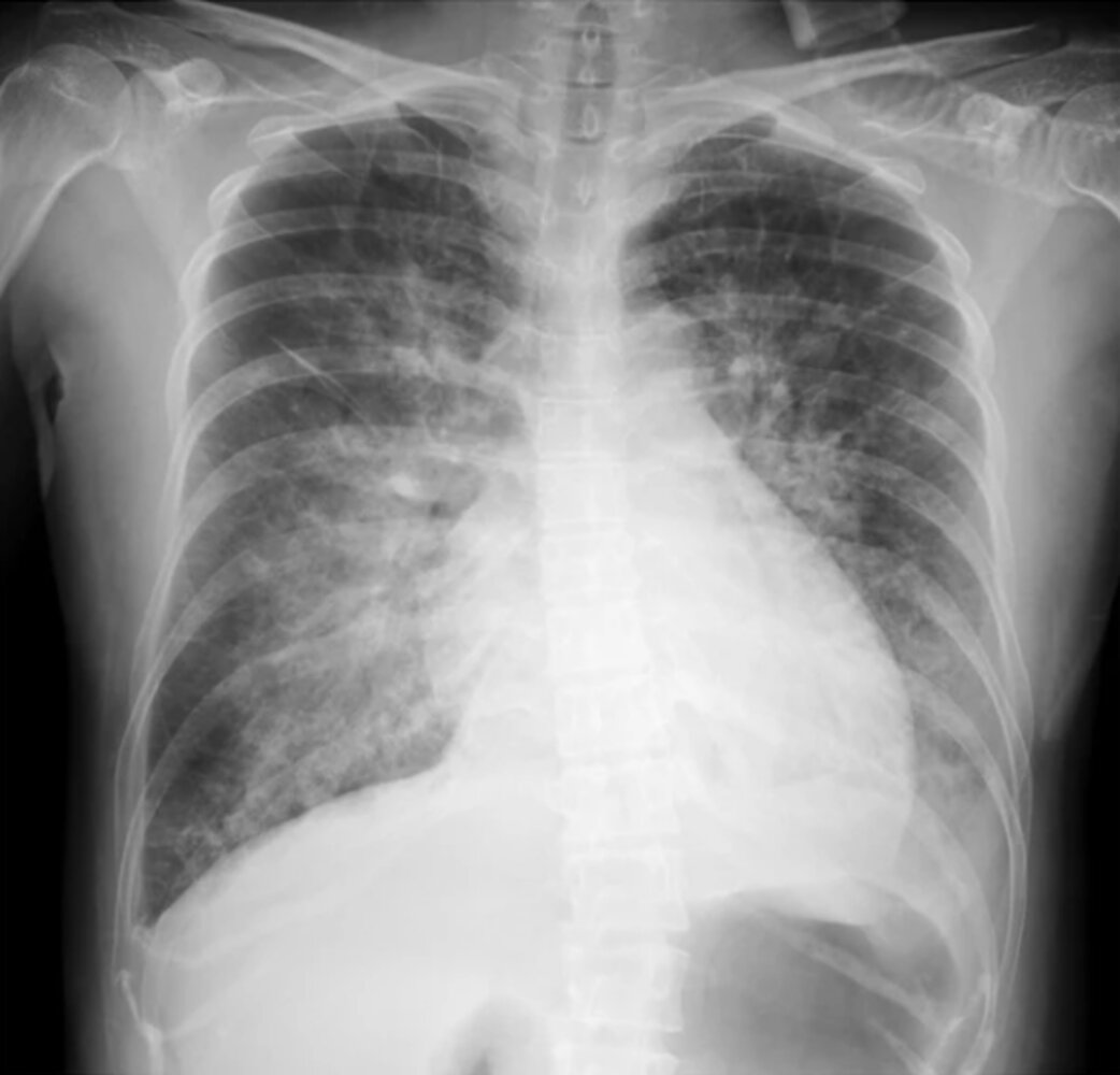 Pulmonary edema