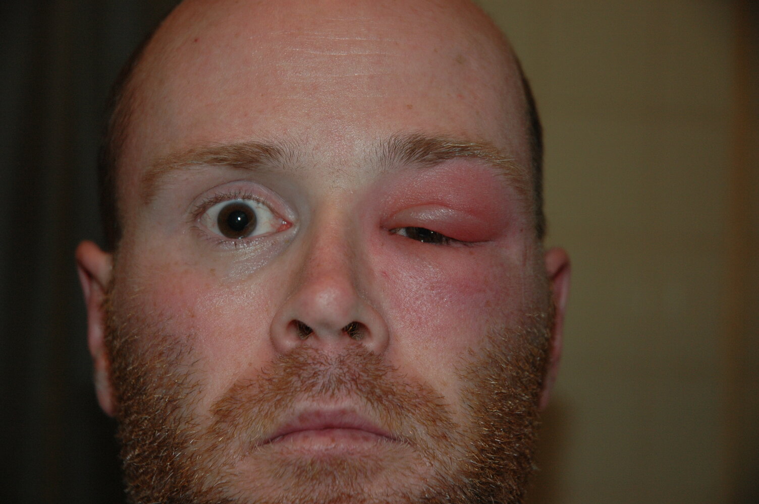 Preseptal cellulitis