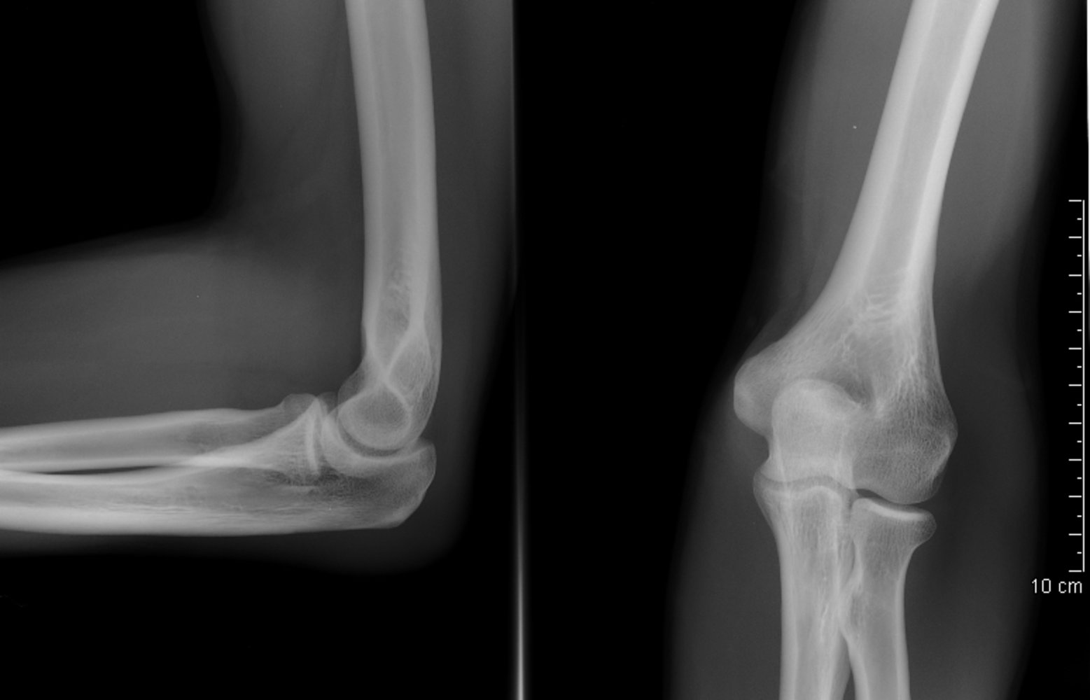 Radiograph of normal elbow