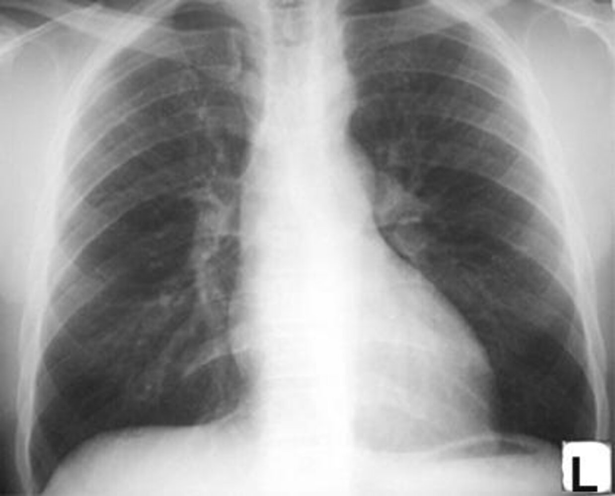 Coarctation of the aorta