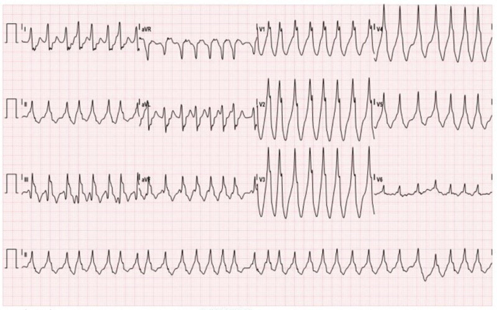 Wolff-Parkinson-White (WPW) syndrome with atrial fibrillation (1/2)