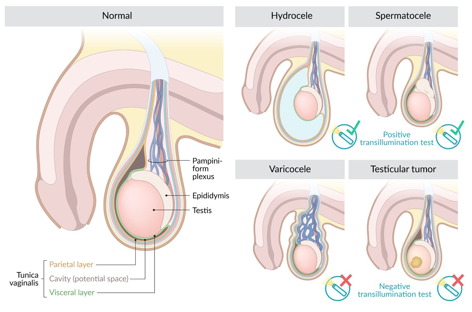 Overview of scrotal abnormalities