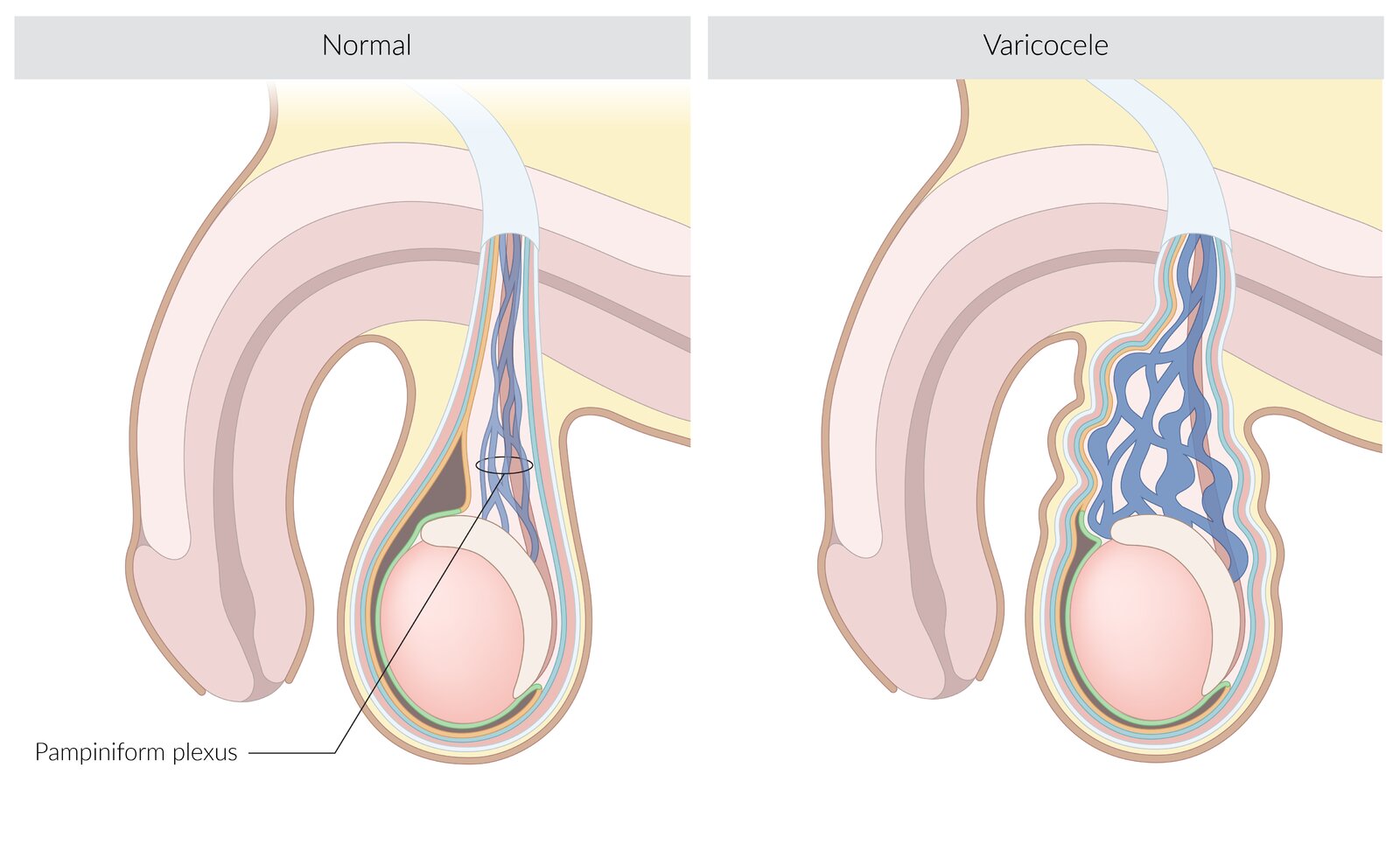 Varicocele