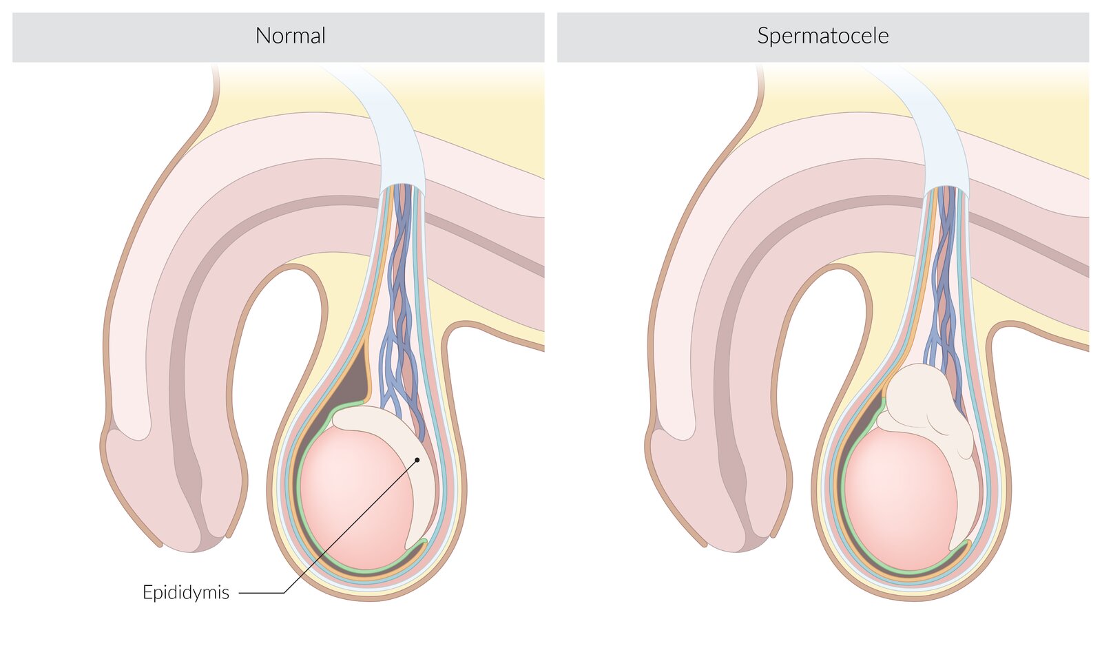 Spermatocele