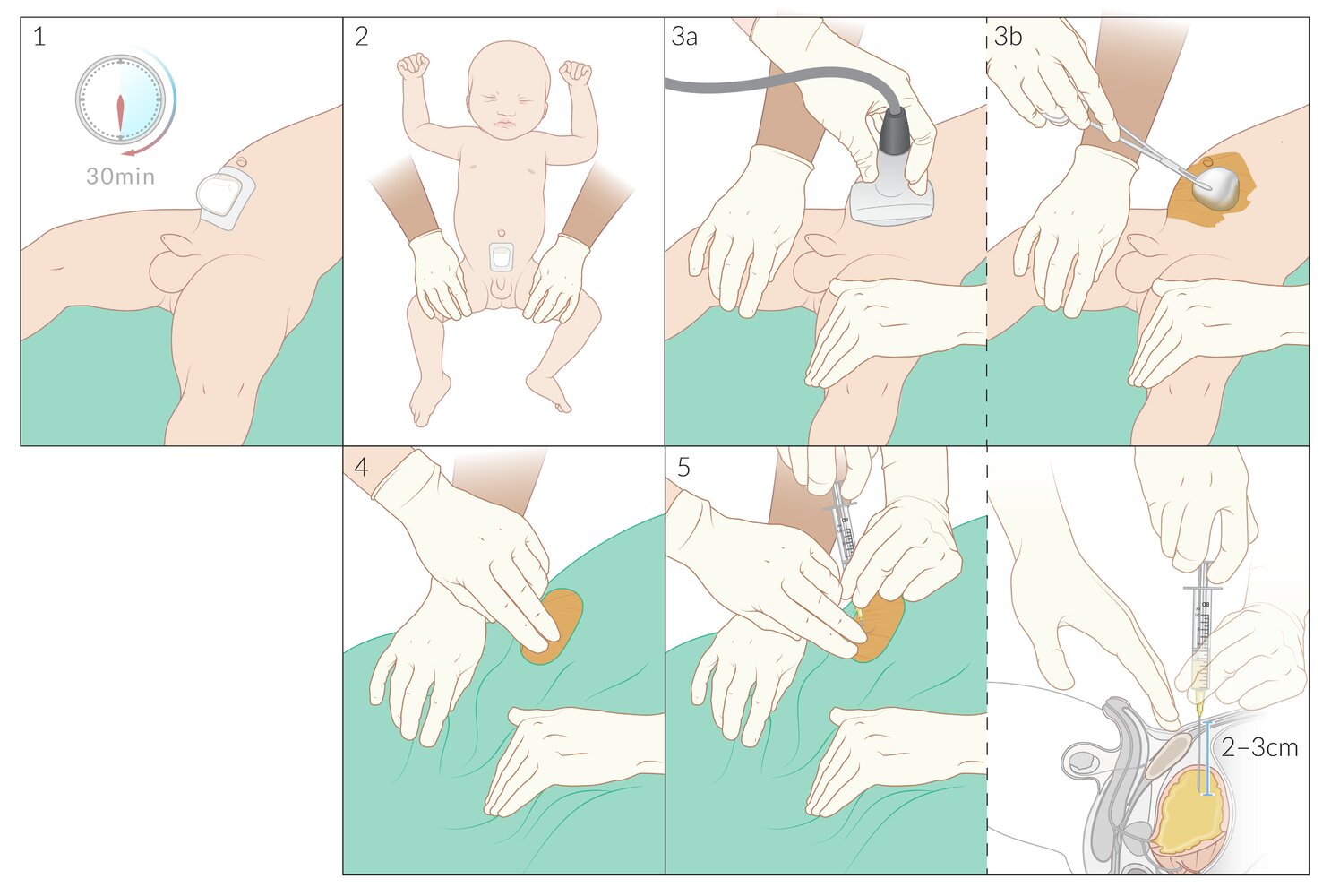 Suprapubic aspiration in infants (technique)
