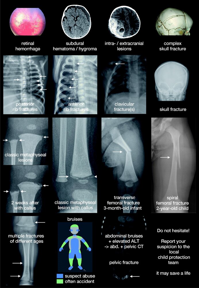 Findings in physical child abuse