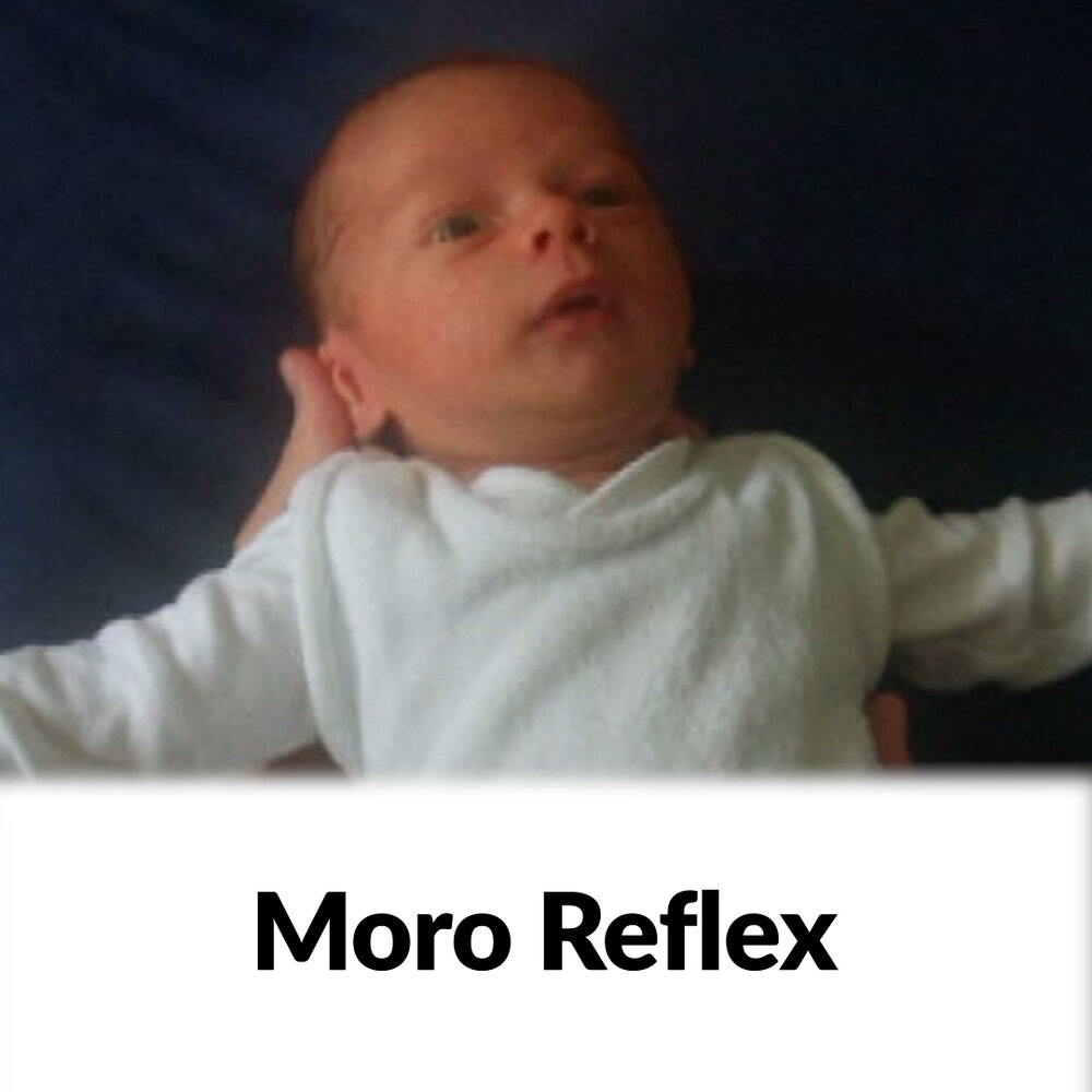Moro Reflex - Clinical Examination