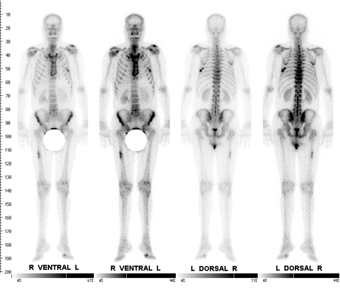Metastasis in bronchial carcinoma