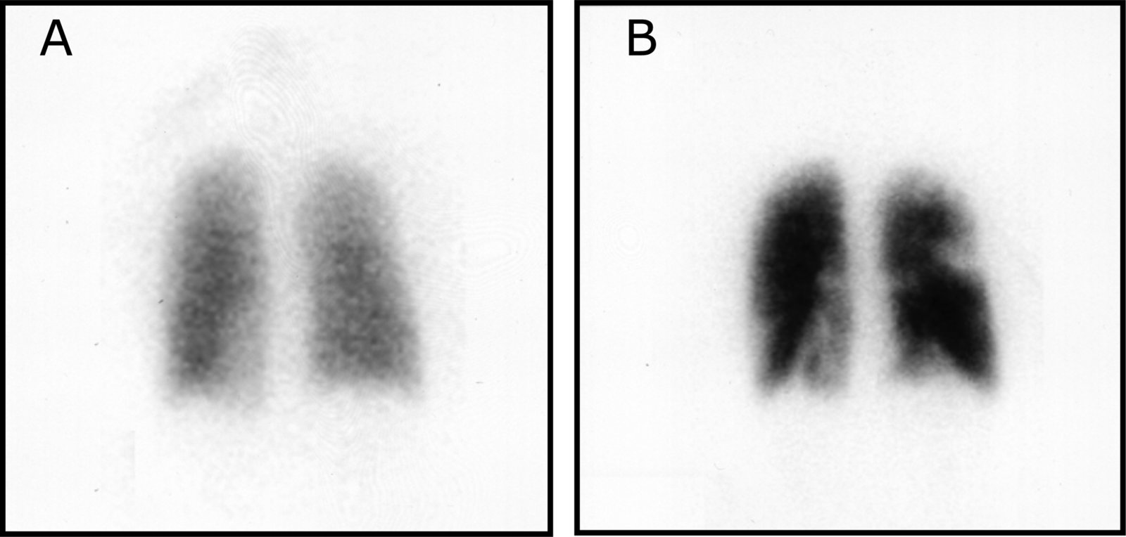 Mismatched perfusion defects from pulmonary emboli