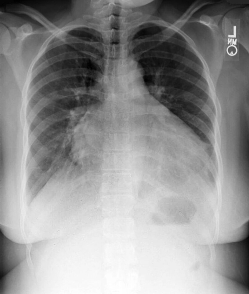 Cardiac silhouette enlargement