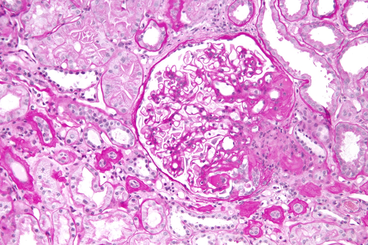 Focal segmental glomerulosclerosis (FSGS)