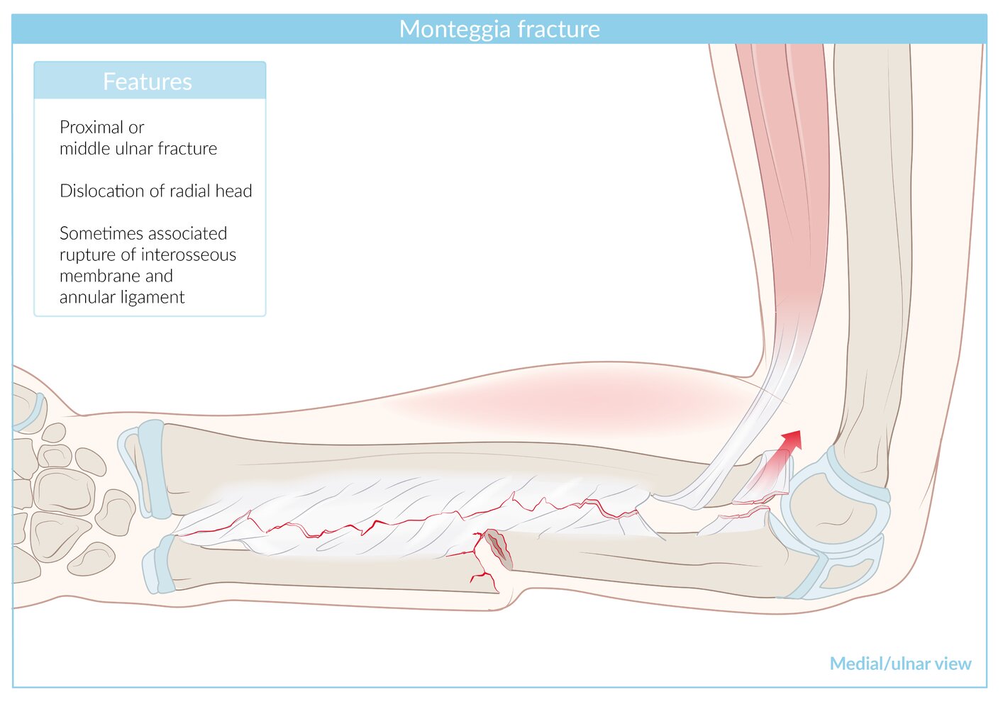 Monteggia fracture