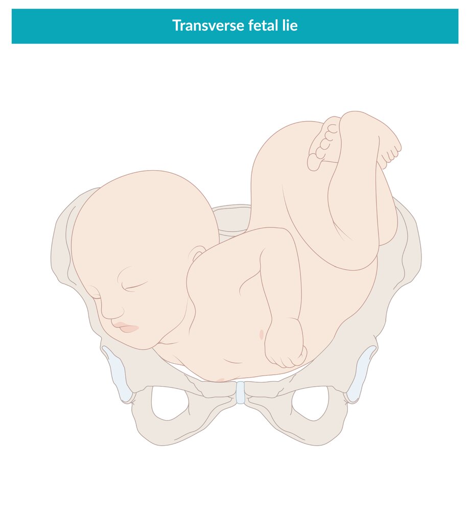 Transverse fetal lie