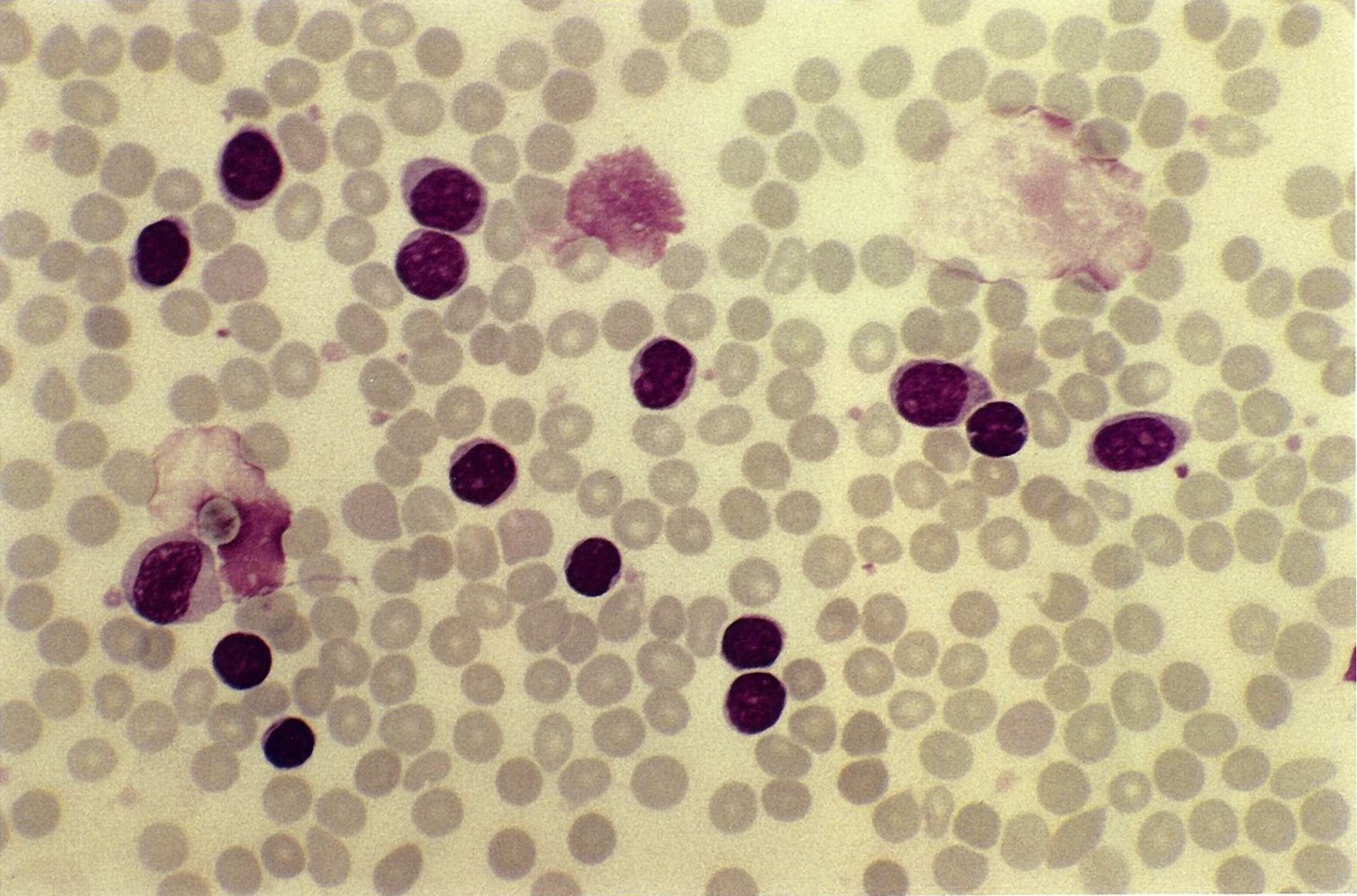 Gumprecht shadows in chronic lymphocytic leukemia (CLL)