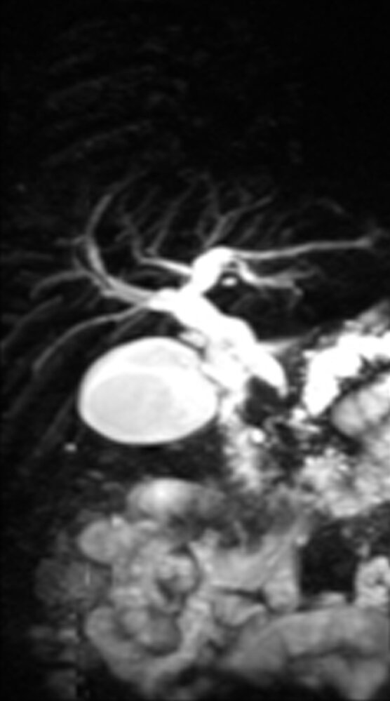 Chronic pancreatitis (MRCP)