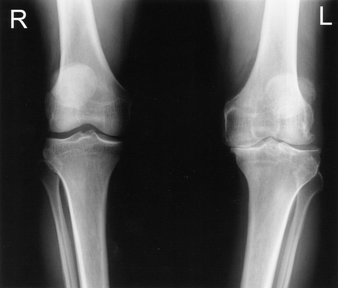 Osteoarthritis of the left knee