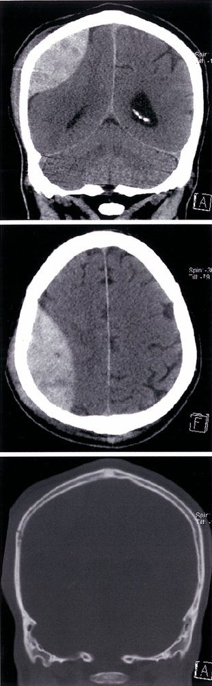 Cranial vault fracture with epidural hematoma
