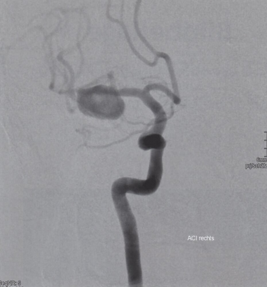 Middle cerebral artery aneurysm