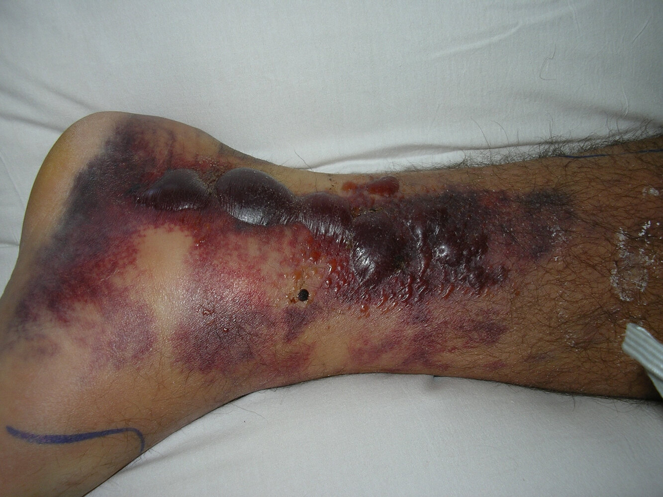 Fracture blisters