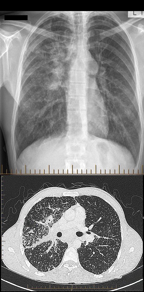 Lymphadenopathy and miliary lung nodules