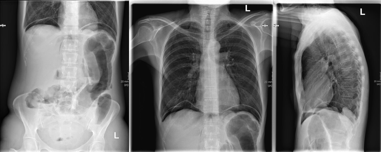 Pneumoperitoneum and Pneumoretroperitoneum
