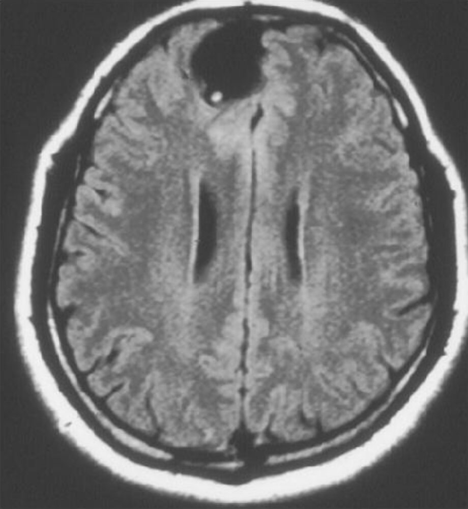 Neurocysticercosis