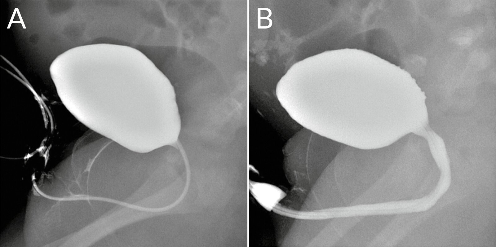 Voiding cystourethrography (VCUG)