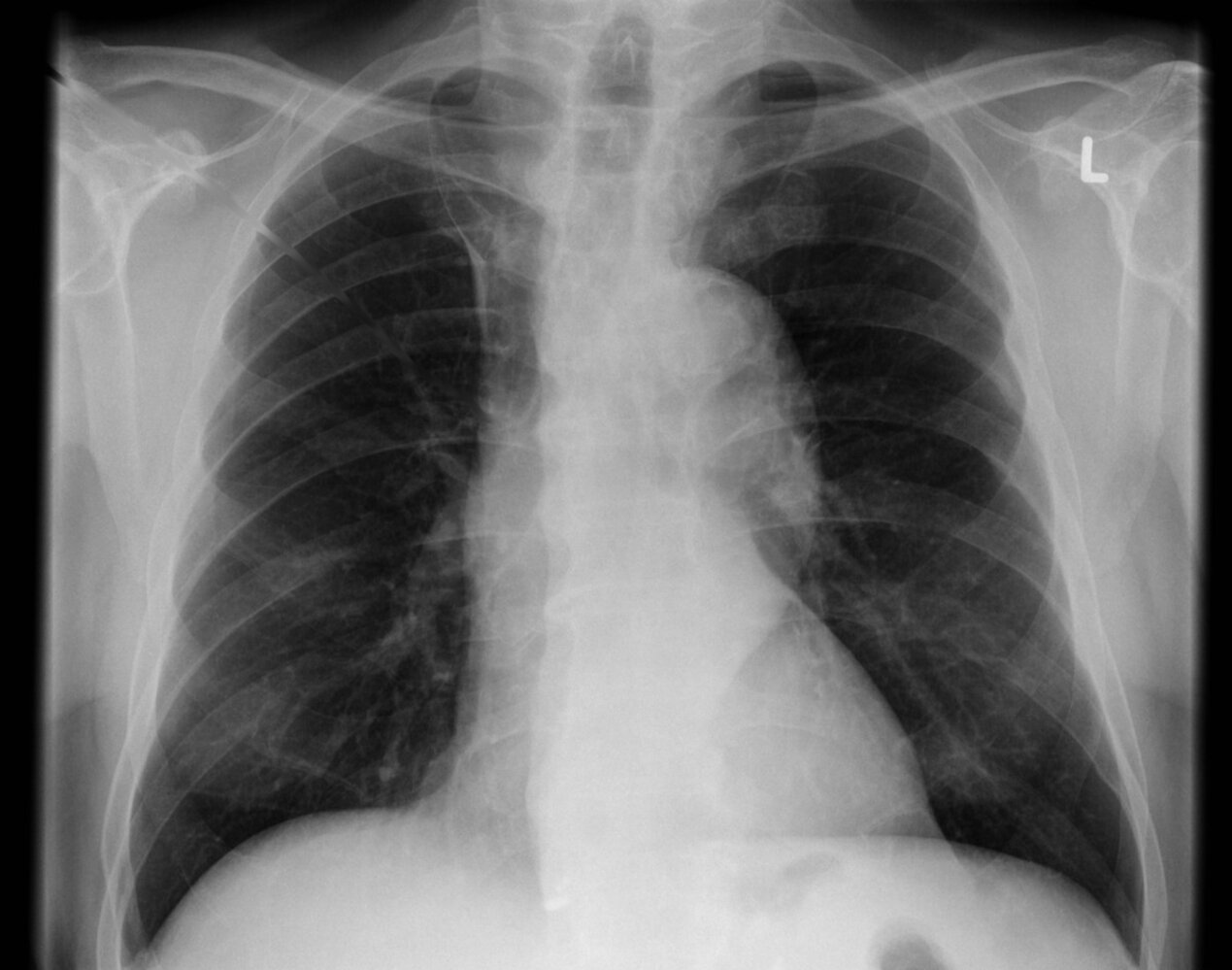 Abnormal contour of thoracic aorta