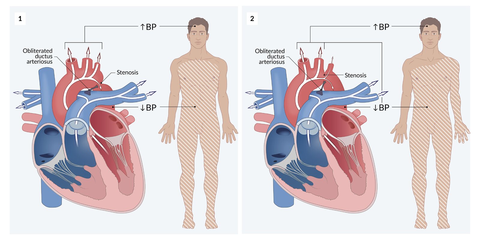 Coarctation of the aorta
