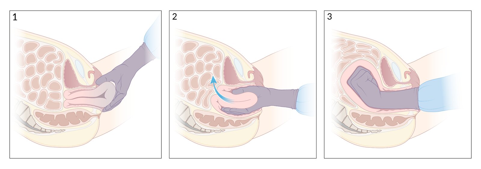 Manual reduction of uterine inversion (Johnson method)