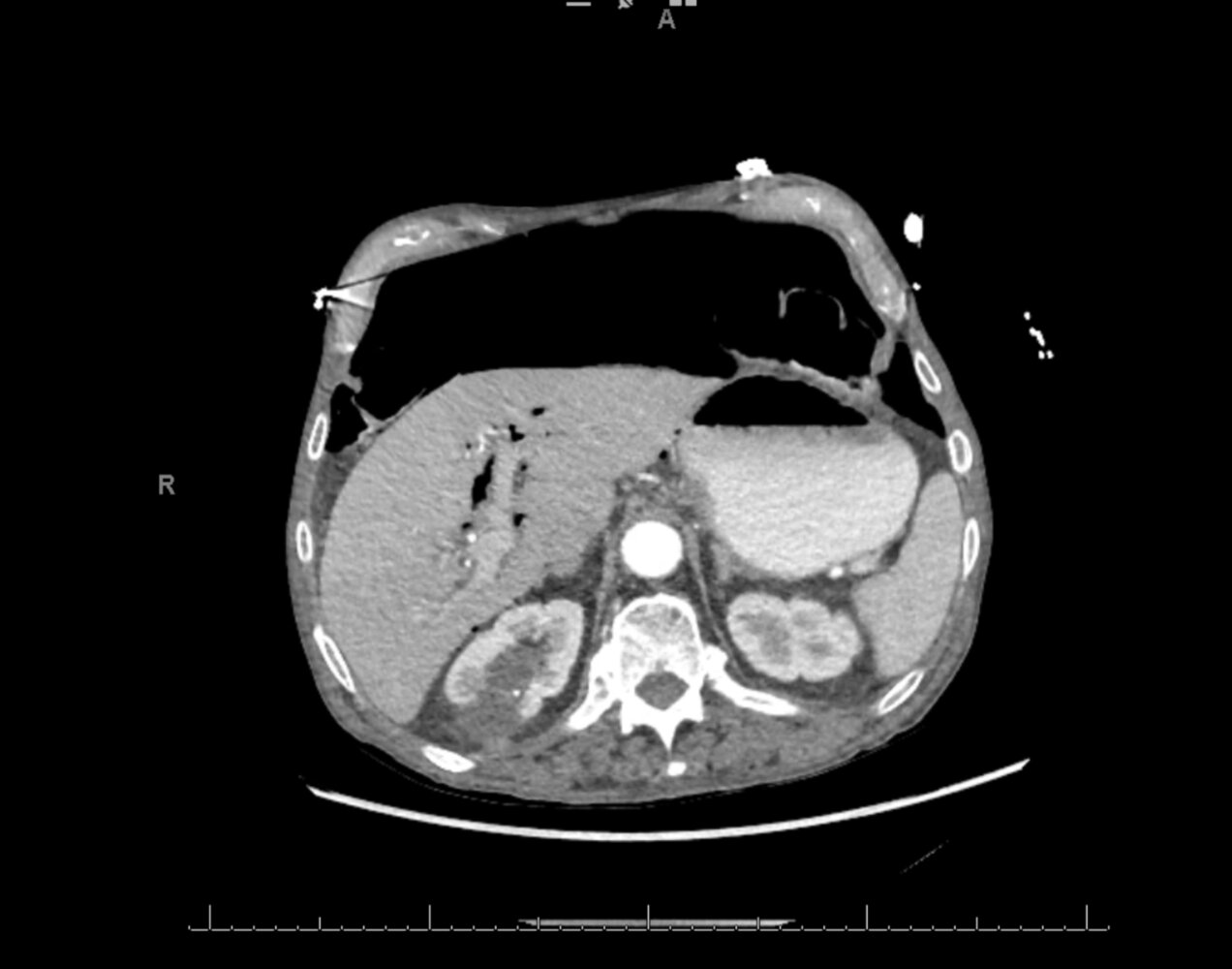 Pneumoperitoneum