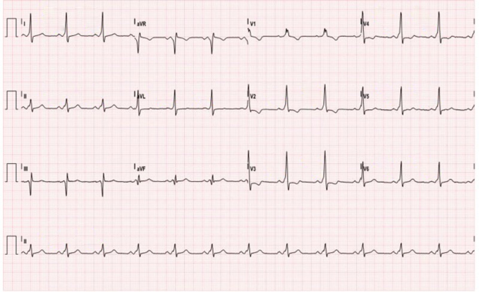 Wolff-Parkinson-White (WPW) syndrome after conversion from atrial fibrillation (2/2)