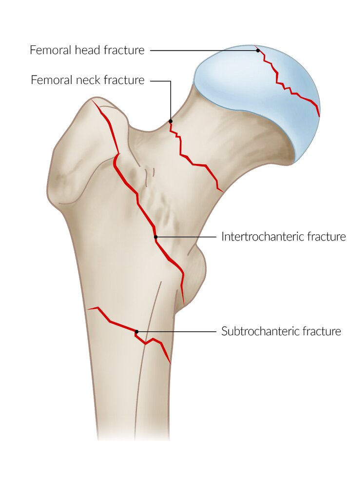 Typical fracture sites of the proximal femur