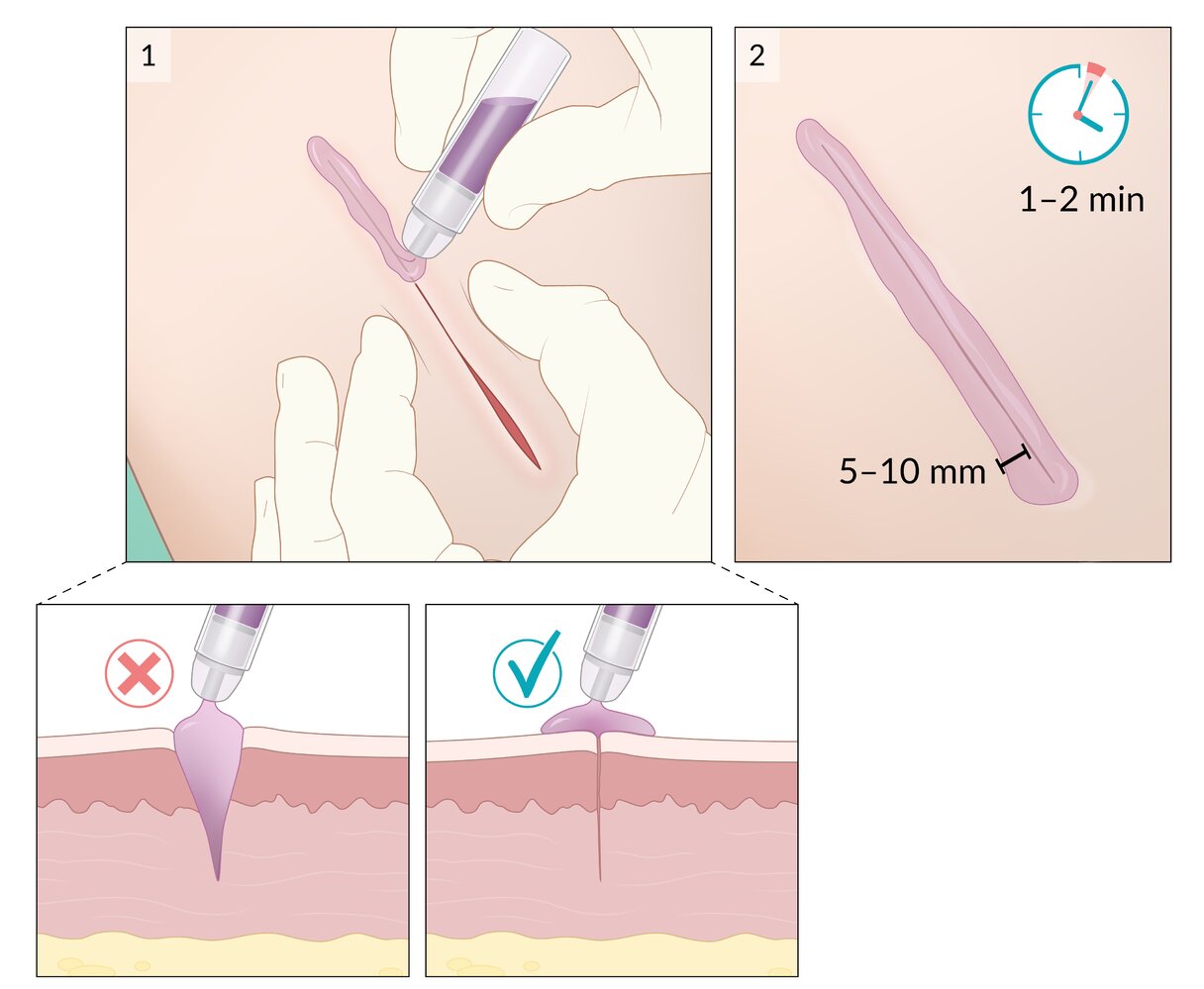 Tissue adhesive