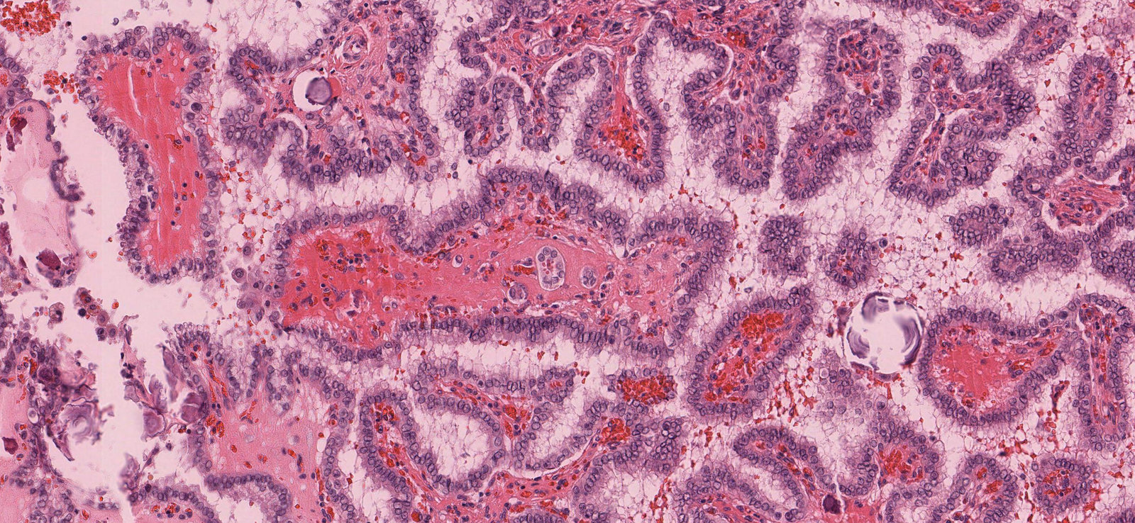 Papillary thyroid carcinoma