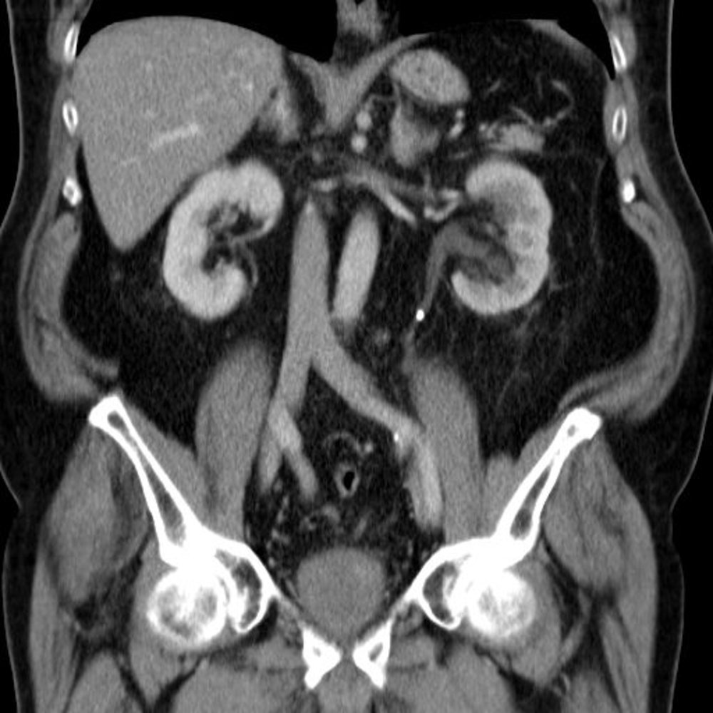 Ureterolithiasis with obstructive uropathy