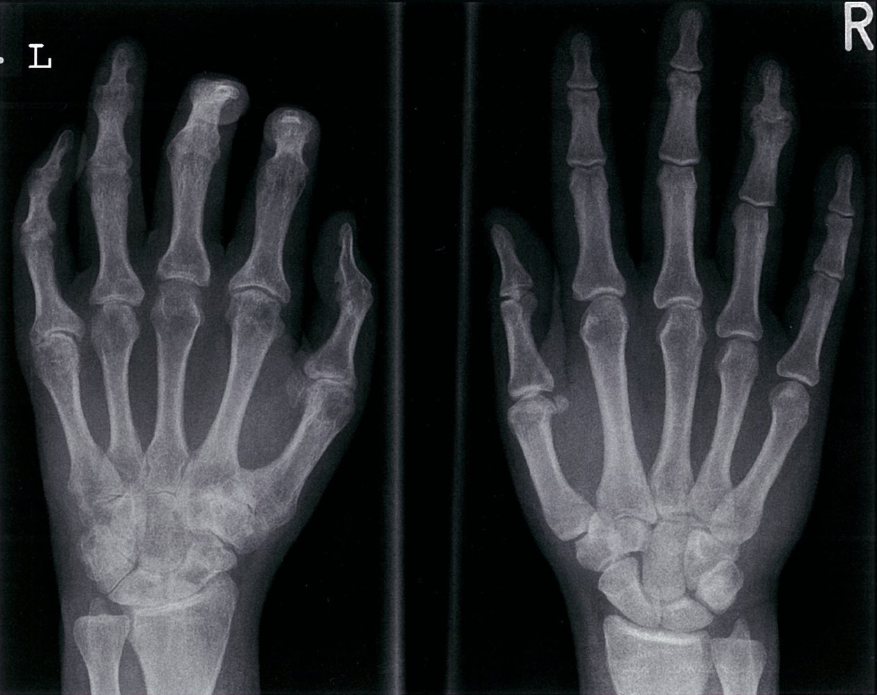 Psoriatic arthritis