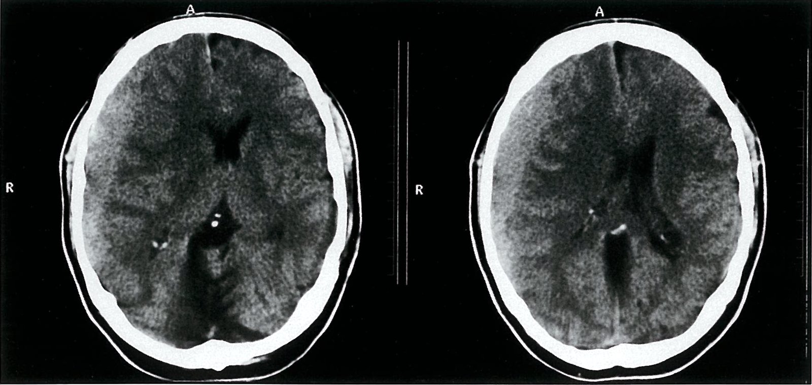 Acute subdural hematoma