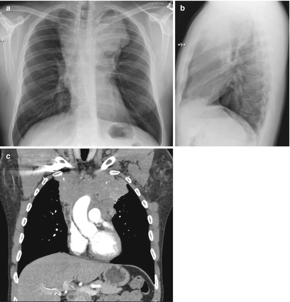 Anterior mediastinal mass in Hodgkin lymphoma