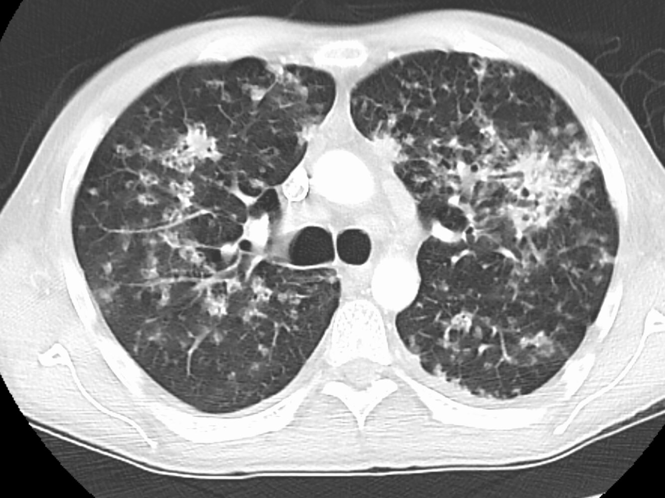 Airway-centered pulmonary disease