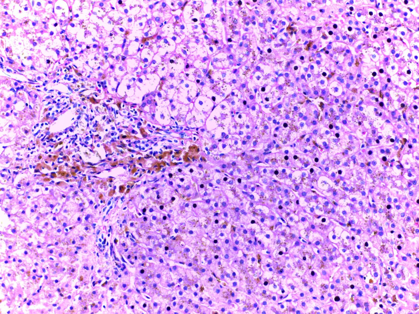 Hemochromatosis of the liver