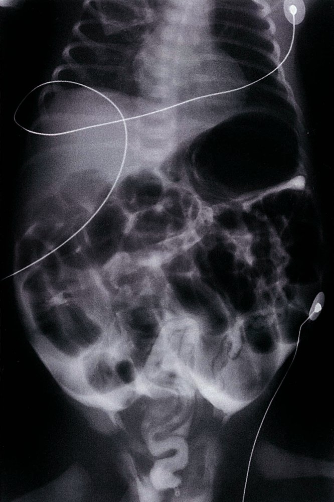 Microcolon and bowel perforation in meconium ileus