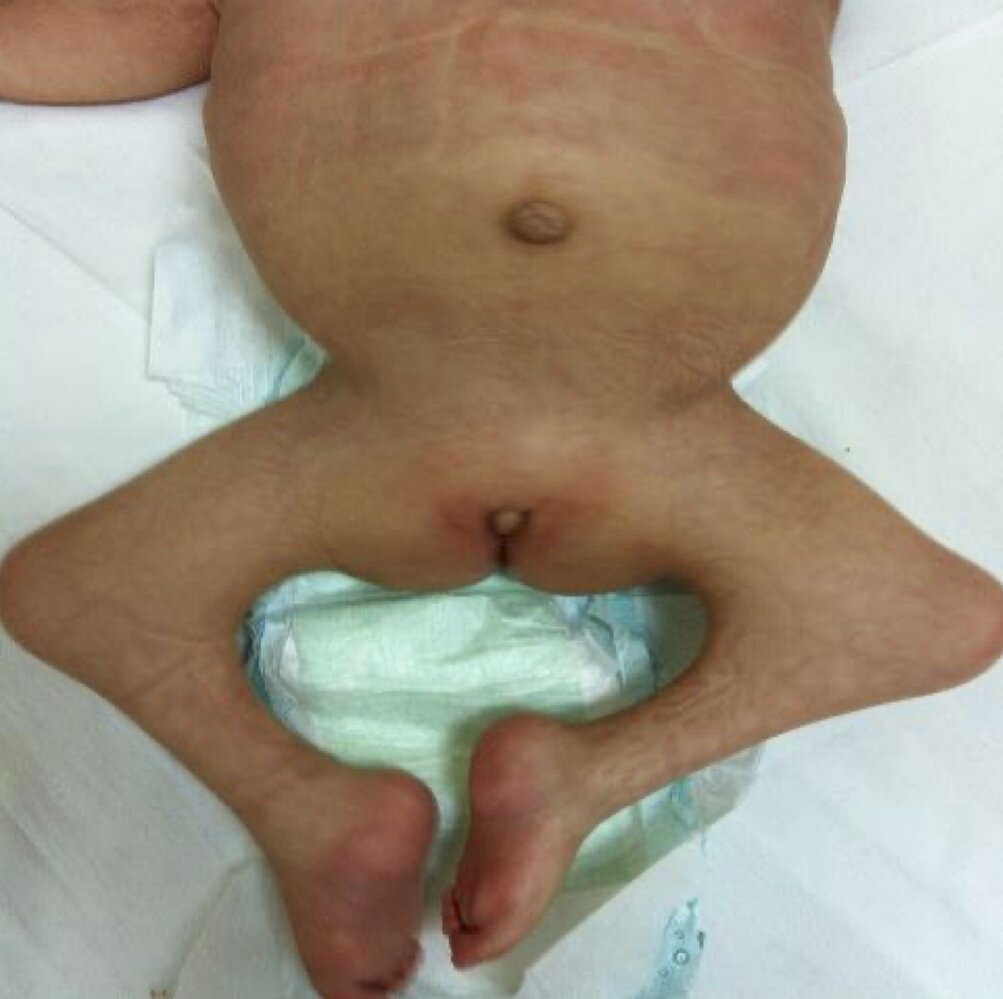 Caudal regression syndrome