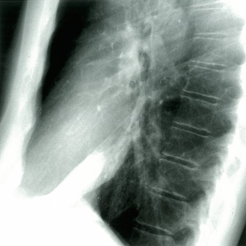 Right lower lobe opacification in pneumonia (2/2)